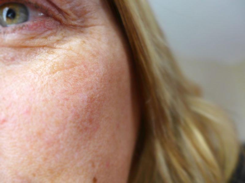 Microneedling Feine Haut Dank Dermaroller Sannes Block